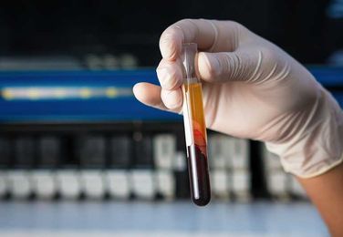 Why Would My Doctor Order a Lipoprotein(a) Blood Test?