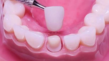 3 ways to keep from paying too much for a dental crown