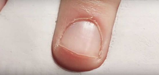 Time-lapse of a fingernail growing
