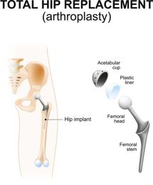 What to Expect After Having a Total Hip Replacement