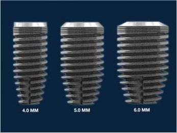 Implant Prevents Bone Loss and Improves Soft-Tissue Preservation