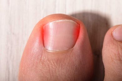 Nail Problems and What to Do About Them