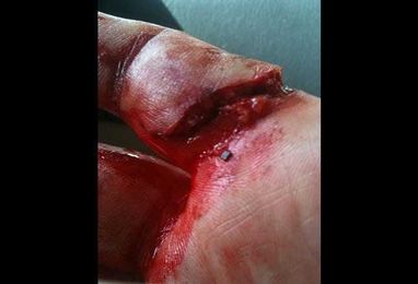 Animal Bites: What You Need to Know