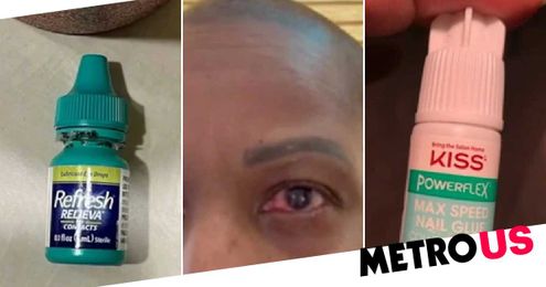 Woman mistakes nail glue for eye drops and seals eyelids shut