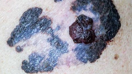 Fast Five Quiz: Melanoma and Other Skin Cancers