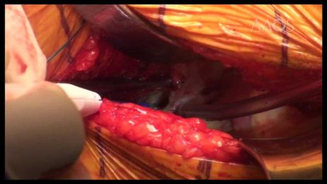 Techniques for Minimizing Instability in Direct Anterior Approach Total Hip Arthroplasty