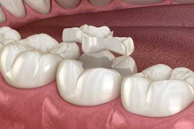 Onlays and Inlays: Choosing the Right Material for Your Mouth