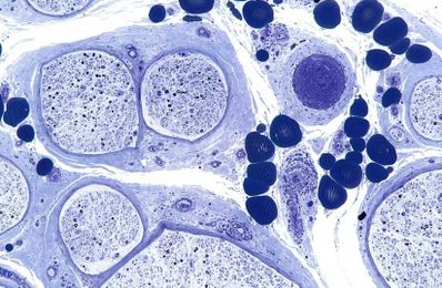 CMT: The most common rare disease that you probably haven’t heard of