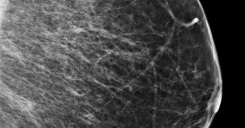 3D mammography approaching 50% of breast imaging systems in the US