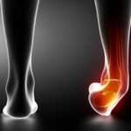 What to Know About Sprained Ankles