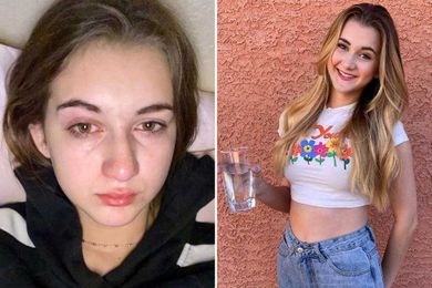 I’m allergic to water — and my own tears feel like acid