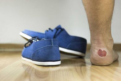 What Is a Friction Blister?