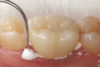 Guidelines for Cementing or Bonding