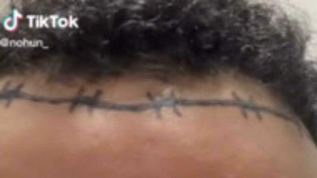 Man's Barbed Wire Tattoo Mistaken for Hair Transplant Scar